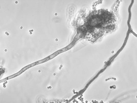 meningitis-outbreak-fungus-4 3 r560