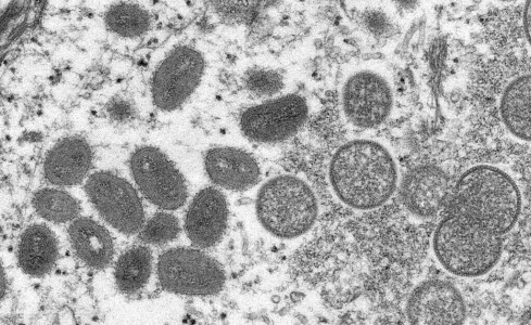 Third possible case of monkeypox found in the US