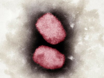 Monkeypox can be stopped outside endemic countries: WHO