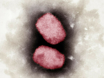 UK records 37 more cases of monkeypox