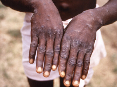 More than 200 cases of monkeypox worldwide: EU disease agency