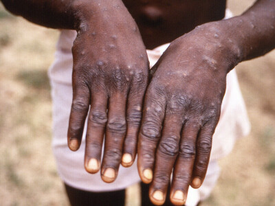 South Africa records first case of monkeypox