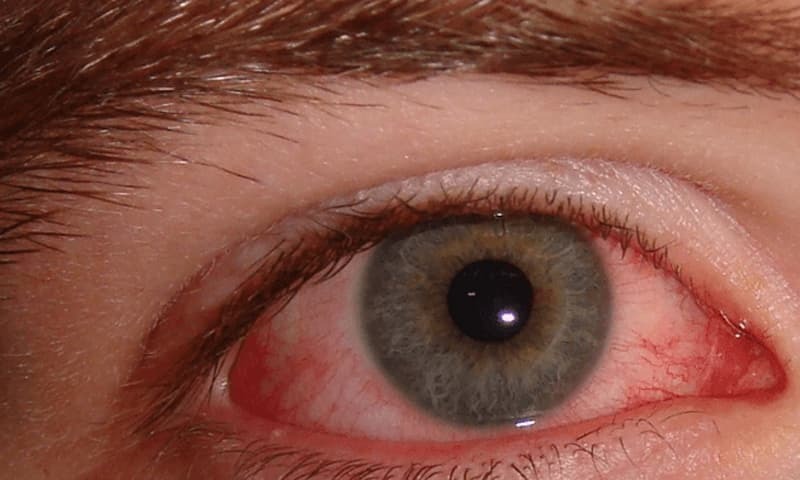 No let up in spread of conjunctivitis