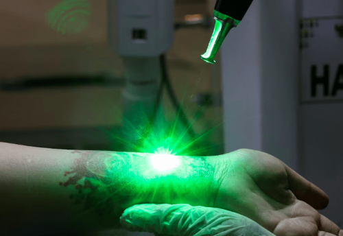 Indonesian Muslims sign up for tattoo removal during Ramadan