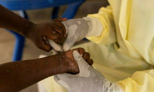 Mpox disease presents hard-to-weigh risks