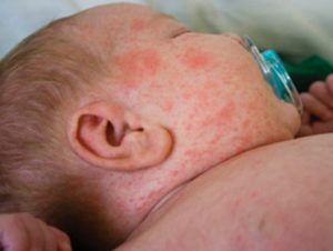One more minor girl dies of measles