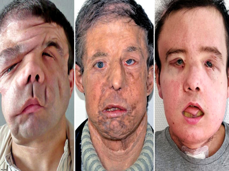 Face transplant essay 08 image