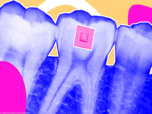Researchers create tooth-mounted sensor to track food